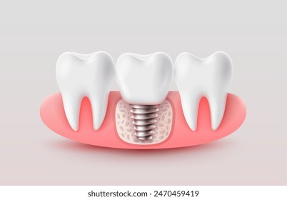 Dental implantation, tooth restoration, symbol on a white background. Vector illustration