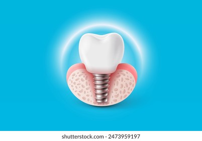 Dental implantation, tooth restoration, symbol on a white background. Vector illustration