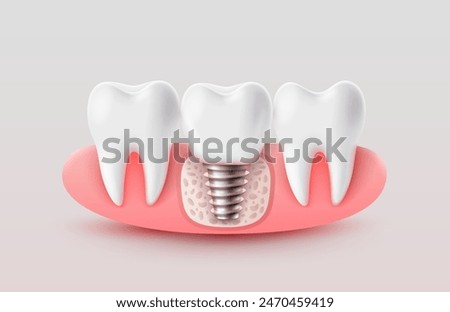 Dental implantation, tooth restoration, symbol on a white background. Vector illustration