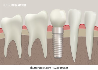 Dental implantation vector illustration. Sound teeth and dental implant on medical illustration