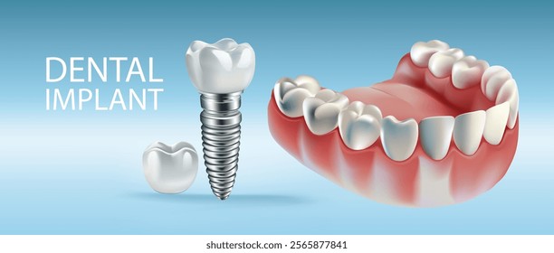 Dental implants on a light blue background, Vector illustration