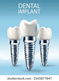 Dental implants on a light blue background, Vector illustration