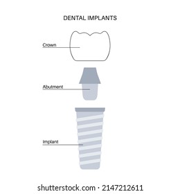 Dental implants surgery concept. Anatomical poster with human teeth. Prosthesis in mouth. Crown abutment and screw medical poster isolated flat vector illustration for clinic or education. .