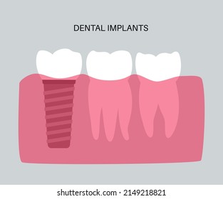 Dental implants surgery concept. Anatomical poster with human teeth. Prosthesis in mouth. Crown abutment and screw medical poster isolated flat vector illustration for clinic or education. .