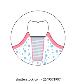 Dental implants surgery concept. Anatomical poster with human teeth. Prosthesis in mouth. Crown abutment and screw medical poster isolated flat vector illustration for clinic or education. .