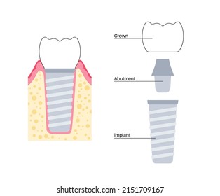 Dental implants surgery concept. Anatomical poster with human teeth. Prosthesis in mouth. Crown abutment and screw medical poster isolated flat vector illustration for clinic or education. .