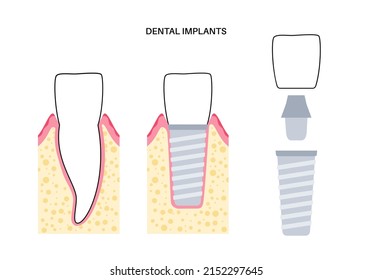 Dental implants surgery concept. Anatomical poster with human teeth. Prosthesis in mouth. Crown abutment and screw medical poster isolated flat vector illustration for clinic or education. .