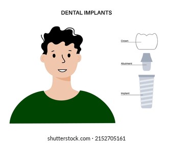 Dental implants surgery concept. Anatomical poster with human teeth. Prosthesis in mouth. Man cartoon character. Crown abutment and screw medical poster isolated flat vector illustration.