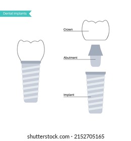 Dental implants surgery concept. Anatomical poster with human teeth. Prosthesis in mouth. Crown abutment and screw medical poster isolated flat vector illustration for clinic or education. .