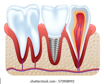 Dental implants and tooth anatomy set model closeup side view realistic image vector illustration