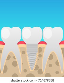 Dental implants, tooth replacement, vector illustration in a cartoon flat style insulated on the topic of dentistry for your projects