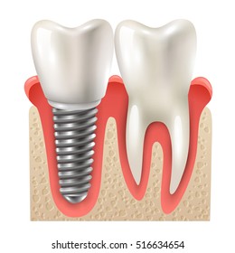 Dental implants and tooth set model closeup side view realistic image vector illustration 