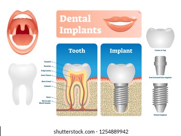 Dental implants vector illustration. Labeled medical scheme with tooth cap. Screwed post with crown compared with natural isolated example. Educational structural diagram with oral surgery technology.