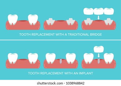 Dental implants versus fixed bridges