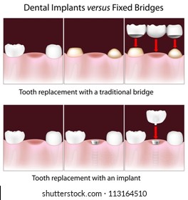 Dental implants versus fixed bridges