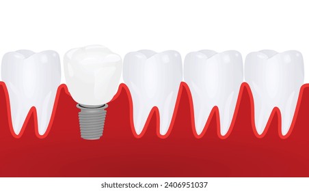 Dental implementation teeth. vector illustration
