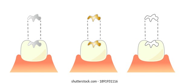 Dental Inlay Caries and Progression and Treatment: Dental Illustration