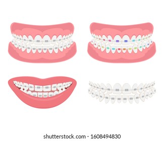 Dental jaw with braces, correct bite of dentition.