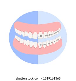 Dental jaw with white teeth before and after braces on the blue background, correct bite of dentition. Dental prosthesis, tooth orthopedics sign, teeth image, icon dental. Vector illustration in flat 