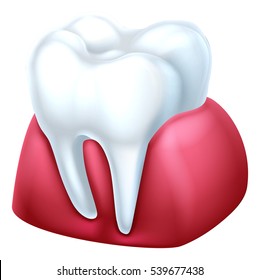 A dental medical illustration of a tooth and gum