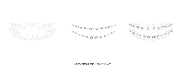 Dental metal braces fitted on teeth and separate templates set, realistic vector illustration isolated on white background. Dental bite correction braces.