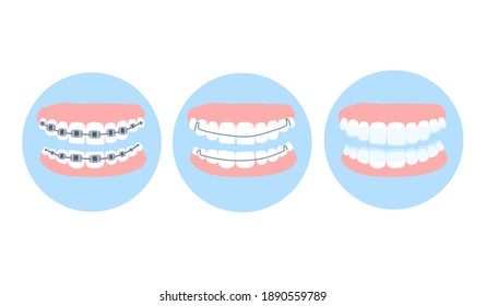 A woman puts on an invisible silicone teeth aligner. Dental braces for  teeth correction 27585141 Stock Photo at Vecteezy