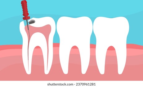 remoción del nervio dental, la brocha de púas se utiliza para eliminar la mayoría del tejido del interior de un diente, una ilustración del material vectorial