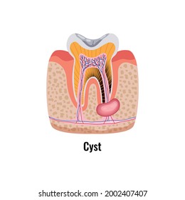 Dental oral problem flat poster and cyst in cavity anatomy vector illustration