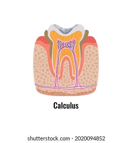 Dental oral problem flat poster with calculus and tooth anatomy vector illustration