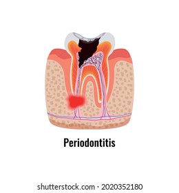 Dental oral problem poster with periodontitis tooth anatomy vector illustration