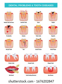 Dental Oral Problems Educational Infographic Set With Caries Inflammation Tooth Plaque Bad Breath Enamel Erosion Vector Illustration 