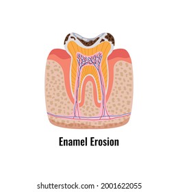 Dental Oral Problems Poster In Flat Style With Enamel Erosion Anatomy Vector Illustration