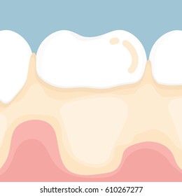  Dental plaque