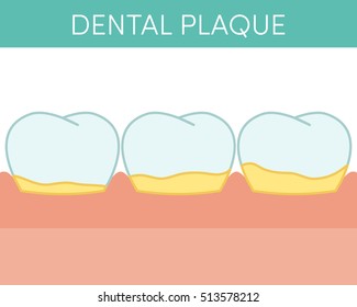 Dental Plaque Concept. Vector Illustration Of Human Molar Teeth With Oral Biofilm