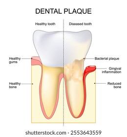 Dental plaque. Gingival inflammation near Bacterial plaque. Healthy tooth and Diseased tooth. Caries formation. Periodontal diseases. Oral biofilm. Bacterial colonization of teeth. Gingivitis