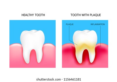 Vector Medical Illustration Realistic Healthy Tooth Stock Vector ...