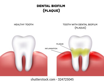 Dental plaque with inflammation and healthy tooth on a white background