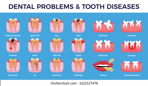 Dental Problems Educational Infographic Info Chart Set With  Caries Pulpit Inflammation Tooth Plaque Enamel Erosion Vector Illustration 