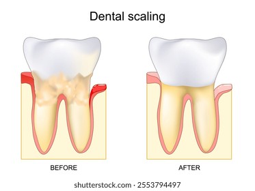 Dental procedure for removing tartar before and after. Dental calculus. Professional cleaning or scaling. Gum disease. Gingival inflammation near Bacterial plaque. Vector illustration