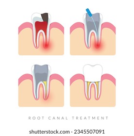 Dental Procedure - Root Canal Treatment - Stock Illustration as EPS 10 File