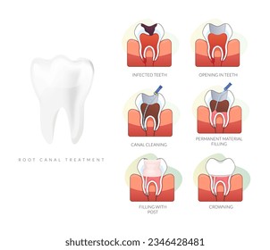 Dental Procedure - Root Canal Treatment - Stock Illustration as EPS 10 File