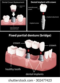 Dental procedures on black illustration