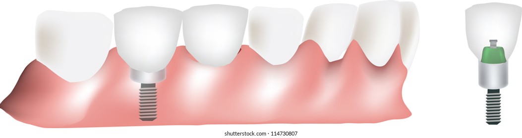 dental prosthesis