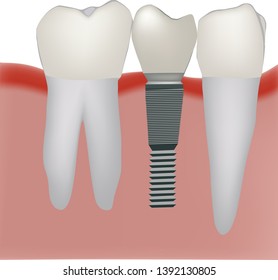 dental prosthesis dental practice implant