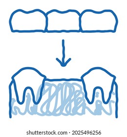 Dental Prosthesis Stomatology sketch icon vector. Hand drawn blue doodle line art isolated symbol illustration
