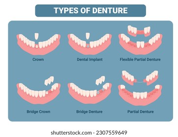 Dental prosthesis types educational medical scheme with names isometric vector illustration. Dentistry implant partial snap in bridge complete full denture modern stomatology restoration treatment