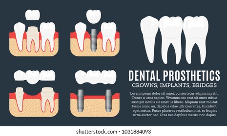 Dental prosthetics illustration. Implant, crown and bridge icons.