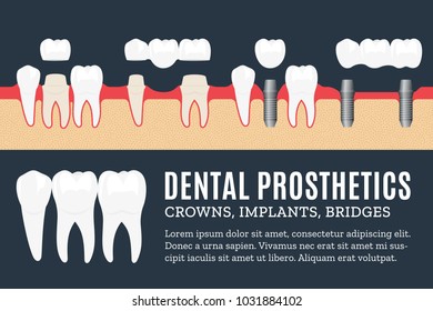 Dental Prosthetics Illustration. Implant, Crown And Bridge Icons.