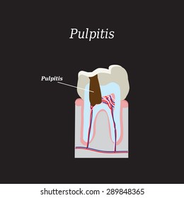 Dental pulp. Vector illustration on a black background.