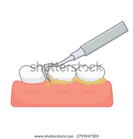 Dental Scaling Procedure with Tartar Scraper Tool Vector Illustration